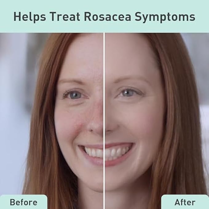 PROcure ROSACARE GENTLE FACE CLEANSER, 8 OZ, HYDRATING CLEANSER WITH HYALURONIC ACID & NIACINAMIDE, FACE WASH FOR SENSITIVE SKIN, RELIEVES ROSACEA SYMPTOMS LIKE REDNESS, FLAKINESS & DRYNESS - Image 2